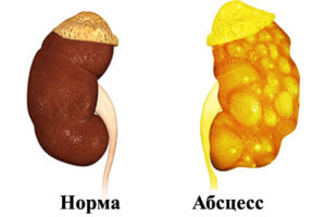 Абсцесс почки при сахарном диабете