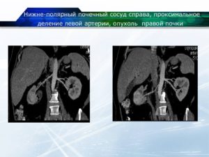 Пиеловазальный конфликт почек лечение