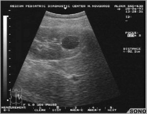 Изоэхогенное образование в почке