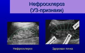Нефросклероз почек на узи