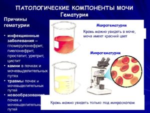 Кровь в моче при заболевании почек