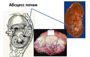 Абсцесс почки при сахарном диабете