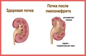 Может быть температура при заболевании почек