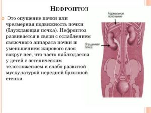 Нефроптоз к какому врачу