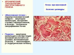 Миеломная болезнь почек