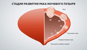 Рак мочевого пузыря прогнозы на жизнь