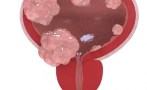 Рак мочевого пузыря прогнозы на жизнь