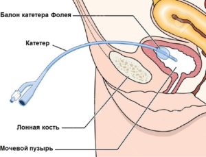 Идет кровь из катетера фолея