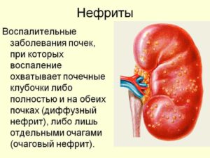 Что такое нефрит почек у детей