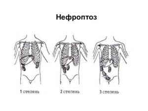Двусторонний нефроптоз как лечить