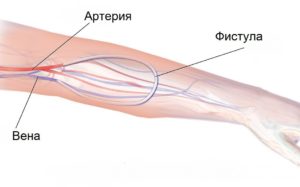 Фистула для гемодиализа