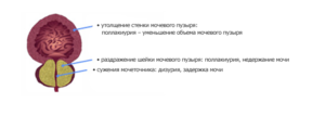 Утолщение стенок мочевого пузыря у ребенка причины лечение