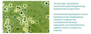 Эритроциты в моче 10 у женщины