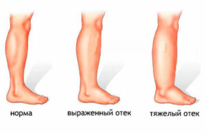 Почечные отеки ног