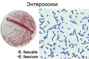 Фекальный энтерококк и беременность