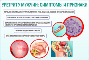 Грибковый уретрит у мужчин симптомы лечение