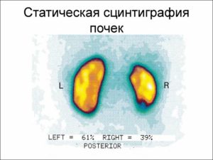 Сцинтиграфия почек противопоказания