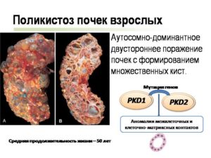 Продолжительность жизни при поликистозе печени и почек