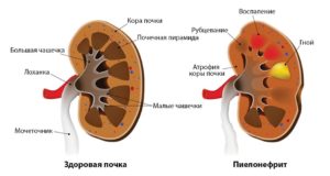 Нефрит симптомы и лечение у детей