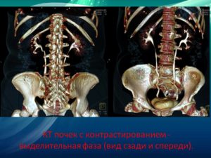 Что такое мскт почек и мочеточников