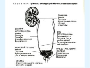 Что такое обструкция мочевыводящих путей