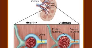 Почки при сахарном диабете 1 типа