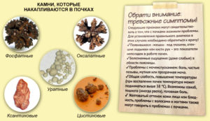 Тошнота при болях в почках