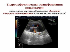 Гидронефротическая трансформация правой почки плода