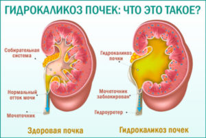 Гидрокаликоз почки у беременных