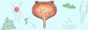 Цистит новобрачных лечение