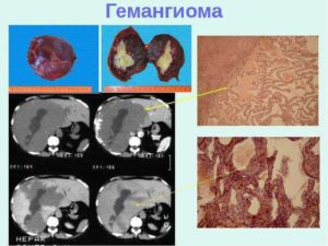 Гемангиома правой почки симптомы