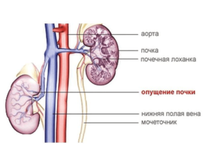 Блуждающая почка у ребенка симптомы