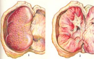 Хронический вторичный пиелонефрит осложнения
