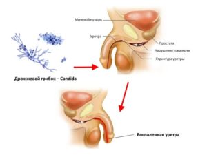 Грибковый уретрит у мужчин симптомы лечение