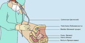 Цистография как проводится