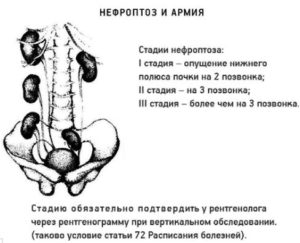 Опущение почки до 1 степени