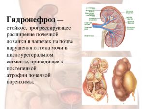 У новорожденного расширены чашечки в почках