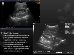 Расширение лоханки почек при беременности
