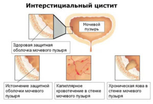 Цистит часто повторяется