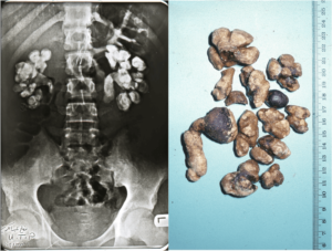 Нефролитиаз обеих почек