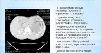 Гидронефроз 3 степени левой почки лечение