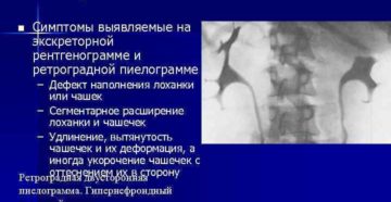 Рентгенологические признаки опухоли почек