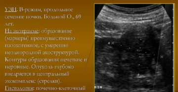 Капсульная опухоль почки