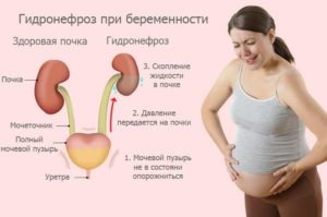 Диета при гидронефрозе почки при беременности