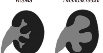 Пиелоэктазия почки плода справа