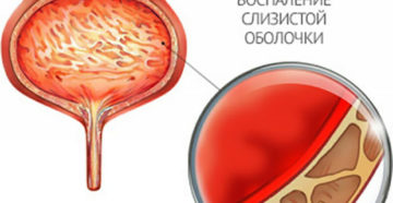 Как лечить мочевой пузырь у женщин