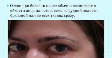 Как снять отек почки