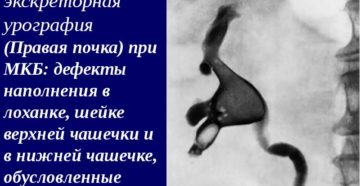 Мкб в правой почке
