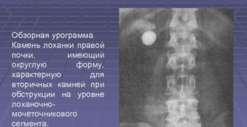 Конкремент лоханки правой почки