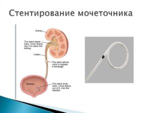 Кровь в моче после стентирования мочеточника